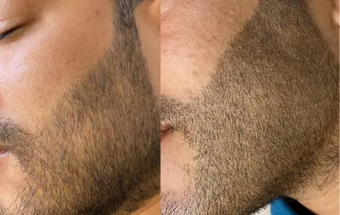 Micro Beard vs. Scalp Micropigmentation - Beard Enhancement Treatments