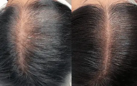 SMP for woman - Scalp Micropigmentation for Women